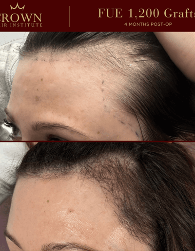 Hair transplant result 1