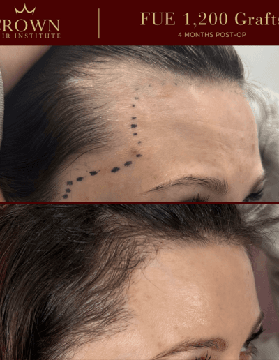 Frontal & Hairline - FUE Before and After