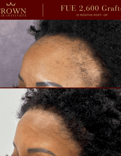 Full Coverage - FUT Before and After
