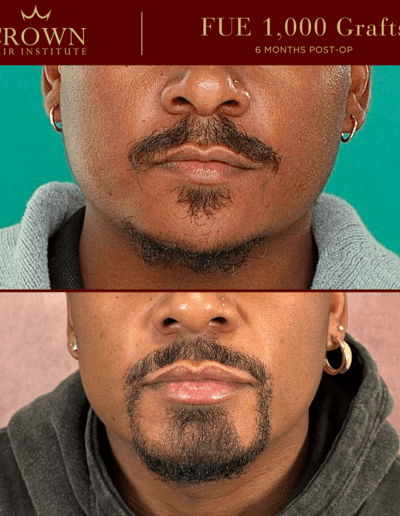 Goatee & Chin - Beard Before and After