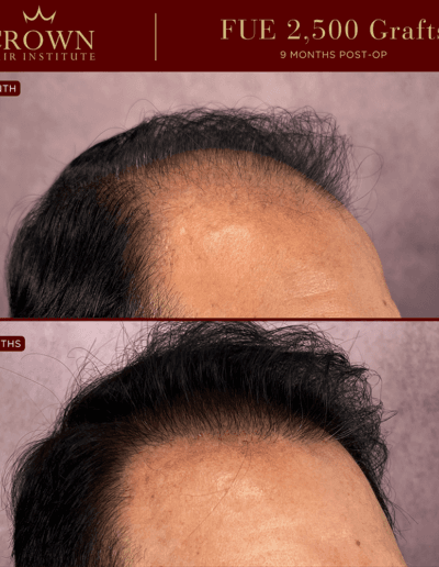 Midscalp Density - FUE Before and After