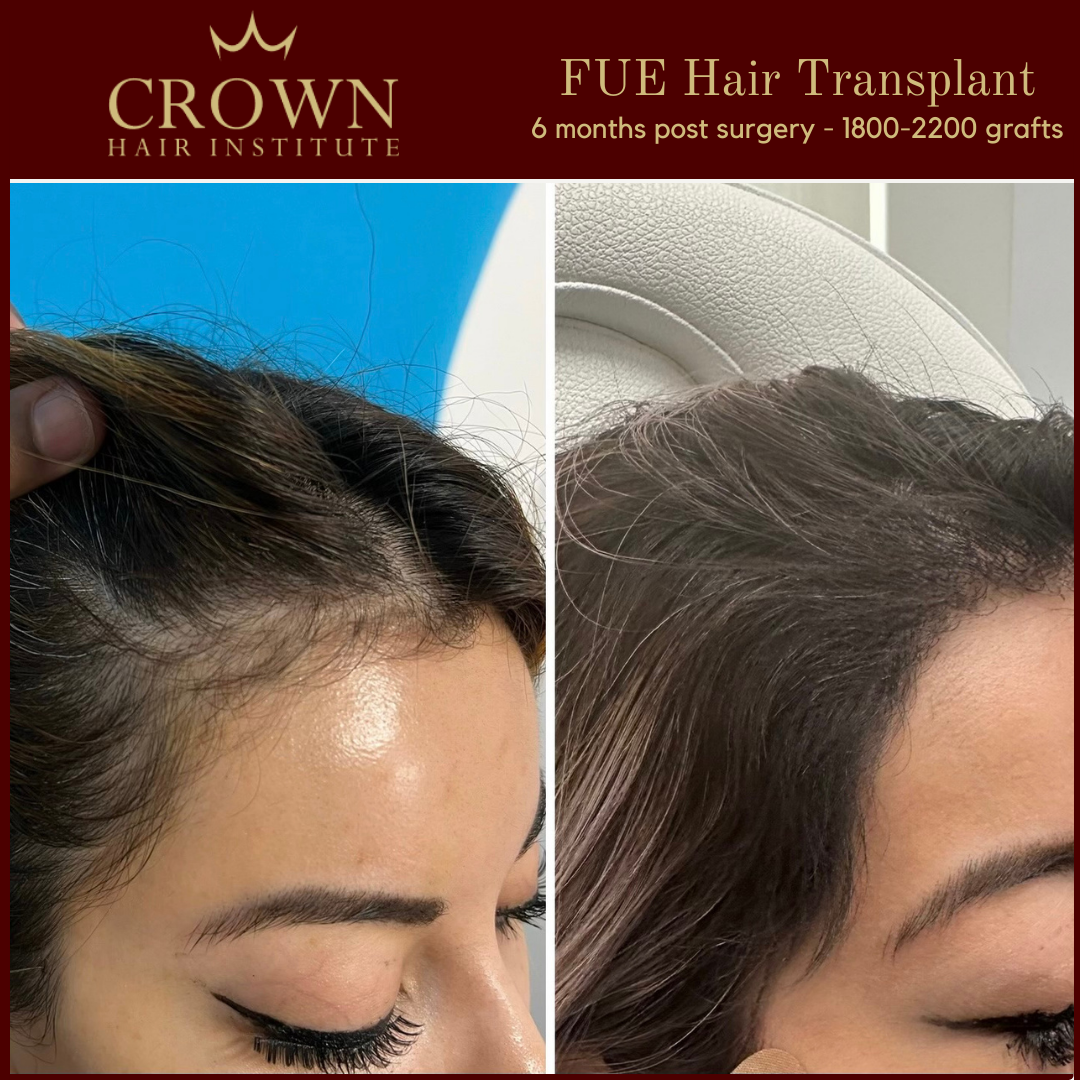 3 Female Hair Restoration in Beverly Hills, CA