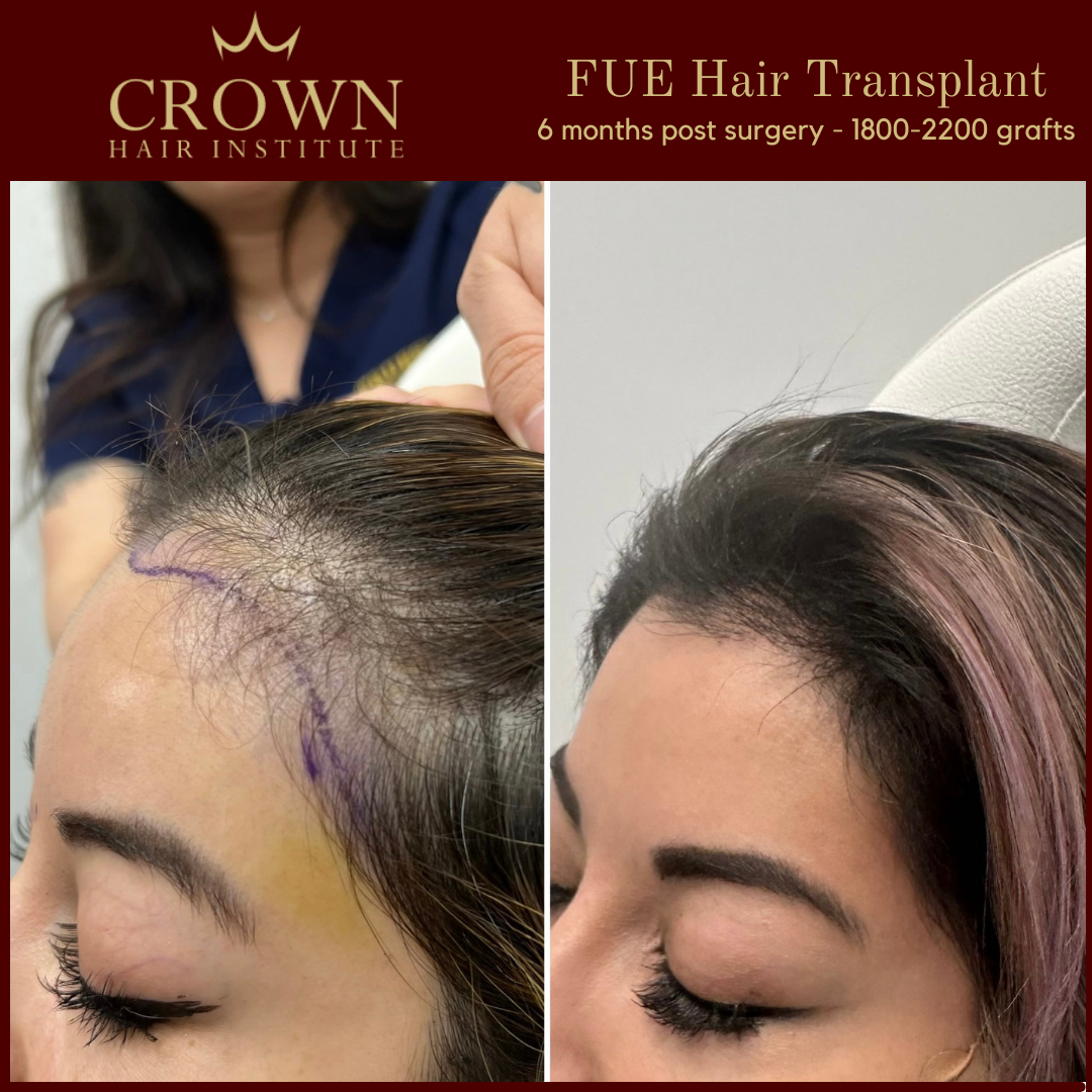 4 Female Hair Restoration in Beverly Hills, CA