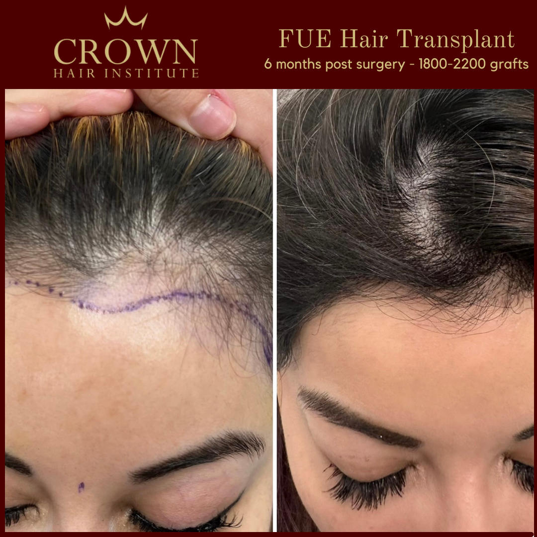 7 Female Hair Restoration in Beverly Hills, CA
